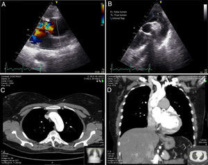 (A) Severe aortic regurgitation due to a prolapse of the cusps; (B) suprasternal view, at the level of the aortic arch, showing an intimal flap (blue arrow) with supravalvar origin and extension to the aortic arch; (C and D) cardiac computed tomography confirming the presence of a Stanford type A aortic dissection. FL: false lumen; TL: true lumen.
