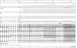 EEF evidenciando inducibilidade de taquicardia ventricular monomorfa com morfologia de BCRE.