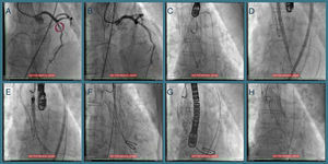 Sequential procedures during the second intervention. (A and B) Percutaneous coronary intervention of the mid left anterior descending artery with a drug-eluting stent; (C) transfemoral transcatheter aortic valve implantation (valve-in-valve) under three-dimensional transesophageal echocardiographic guidance, the Medtronic CoreValve® being immobilized with a 15 mm snare loop by a radial approach; (D) aortic valve balloon valvuloplasty performed with a 20 mm NuMED Nucleus balloon, followed by (E and F) implantation of a 25 mm St. Jude Portico® valve; (G) this valve was underexpanded and post-dilation was performed after changing the Amplatz super stiff wire for a backup Meier wire in order to advance the Nucleus balloon; (H) final result.