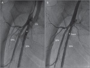 (A) Angiography obtained from the contralateral femoral artery (left) revealing a high-output arteriovenous fistula between the right superficial femoral artery and femoral vein (white asterisk); (B) angiography after implantation of a 26 mm×4.5 mm PK-Papyrus covered coronary stent (white asterisk) revealing complete sealing of the AV fistula. DFA: deep femoral artery; FV: femoral vein; SFA: superficial femoral artery.