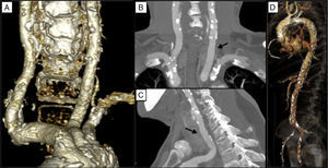 (A) Three-dimensional computed tomography view of the supra-aortic vessels; (B and C) computed tomography of the supra-aortic vessels showing absence of stenosis in the left common carotid artery (black arrow); (D) porcelain aorta.