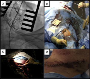 (A) Radioscopic view of transcarotid access; (B) positioning of the team; (C) detail of the surgical exposure; (D) suture result four days after the procedure.