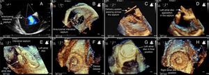 Percutaneous closure of ostium secundum atrial septal defect, associated with aneurysm of the atrial septum, using three-dimensional transesophageal echocardiography imaging (see text for details).