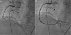 Coronariografia direita: (A) oclusão do segmento médio da artéria coronária direita; (B) reperfusão após aspiração de trombo.