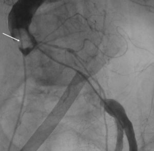 Aortografia: oclusão da aorta abdominal por trombo gigante (seta).