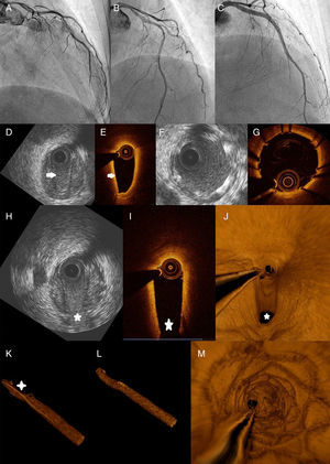 (A-C) Coronary angiograms, cranial view: (A) at presentation, the flow is clearly diminished (TIMI 1-2); (B) after implantation of the first stent; (C) final angiographic result; (D and E) IVUS and OCT, respectively, of the mid segment of the left anterior descending artery. White arrows indicate the intimal flap; (F and G) IVUS and OCT, respectively, after stent implantation, showing correct expansion and apposition; (H and I) IVUS and OCT, respectively, displaying the hematoma at the origin of a patent septal branch (star); (J) three-dimensional (3-D) OCT reconstruction at the same level as (I); (K) 3-D reconstruction after implantation of the first stent. The cross shows the hematoma and the luminal compromise; (L and M) final 3-D result. IVUS: intravascular ultrasound; OCT: optical coherence tomography.