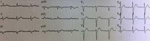 Previous electrocardiogram performed six months previously (essentially normal).