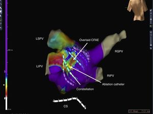 Posteroanterior view of the left atrium showing a stable complex fragmented atrial electrogram (CFAE) defined by dynamic overlaid mapping. Anatomy defined by the Ensite NavX™ system; electrograms recorded by basket catheter (Constellation, Boston Scientific); ablation performed by ablation catheter (yellow) located over the area of a stable CFAE (white arrow). CFAE: complex fractionated atrial electrogram; CS: coronary sinus; LIPV: left inferior pulmonary vein; LSPV: left superior pulmonary vein; RIPV: right inferior pulmonary vein; RSPV: right superior pulmonary vein.