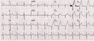 Eletrocardiograma realizado após início da dor torácica: ritmo sinusal, frequência de 72bpm, supradesnivelamento de ST de cerca de 2 a 4mm em V2 a V6, DI e AVL.