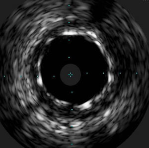 Intravascular ultrasound showing correct stent apposition and expansion in the left main.
