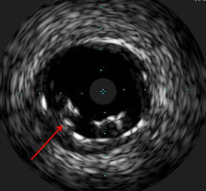 Intravascular ultrasound with the probe positioned outside the stent. The arrowhead shows reintroduction of a second wire within the stent lumen.