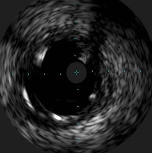 Intravascular ultrasound showing the crushed stent regaining its cylindrical shape after multiple balloon dilatations within the stent lumen.