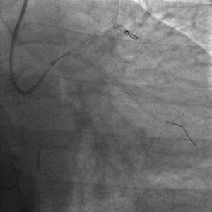 A second drug-eluting stent is implanted in the ostial proximal left main overlapping with the previous stent and covering the proximal end dissection.