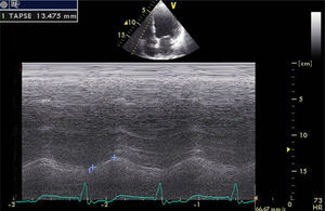 Measurement of tricuspid annular plane systolic excursion by M-mode echocardiography.