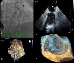 (A) Implantation of a 22 mm Amplatzer™ Cardiac Plug (ACP); (B) three-dimensional transesophageal echocardiography guidance of the procedure; (C) thrombus on atrial surface of the ACP on two-dimensional transesophageal echocardiography (white arrow); (D) three-dimensional transesophageal echocardiography showing thrombus on the device (zoom mode).