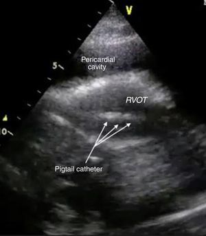 Long-axis parasternal transthoracic echocardiographic view showing the pigtail catheter in the right ventricle. RVOT: right ventricular outflow tract.