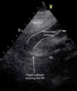 Subxiphoid transthoracic echocardiography showing a large pericardial effusion and the catheter passing through the right ventricular wall. RV: right ventricle.
