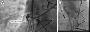 (A) Saphenous vein graft stump occluded with fresh thrombus; (B) SVG after successful intervention. RCA: right coronary artery; SVG: saphenous vein graft.
