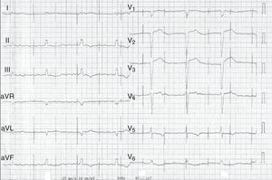 ECG realizado após síncope, evidenciado ritmo próprio – flutter auricular – com sinais de disfunção de pacemaker (undersensing e falhas de captura ventricular).