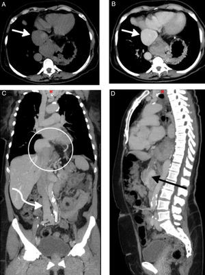 Angiotomografia de tórax, abdome e pelve sem contraste em A e com contraste na fase venosa em B, C e D, demonstrando veia cava inferior com dilatação aneurismática na região proximal junto à desembocadura na aurícula direita, atingindo no maior calibre 56mm (seta branca reta). As drenagens das veias hepática média, direita e esquerda, ocorrem na porção aneurismática, que está herniada para a região torácica com parte do segmento hepático (círculo branco). Distalmente ao aneurisma, na porção intra‐hepática, a veia cava inferior tem calibre muito reduzido, praticamente colapsada, por uma distância de 35mm (seta preta). A veia cava inferior assume aspeto e calibres normais apenas na região sub‐hepáticas, recebendo a drenagem das demais veias abdominopélvicas (seta branca curva).
