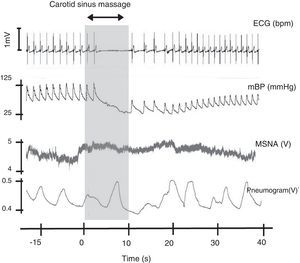 Carotid sinus massage. This figure shows the relation between cardiovascular variables, ventilation and muscle sympathetic nerve activity on sinus massage in a healthy subject. ECG: electrocardiogram; mBP: mean blood pressure; MSNA: muscle sympathetic nerve activity. Rocha and Laranjo, unpublished data.