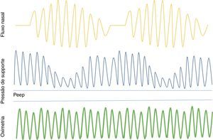 Servo‐ventilação adaptativa – mantém a via aérea patente através da pressão positiva no final da expiração (PEEP) e fornece pressão de suporte inspiratória durante a ventilação espontânea. Quando ocorre apneia, aumenta a pressão de suporte ou fornece ventilação mínima de reserva. Assim que volta a ventilação espontânea, o suporte diminui.