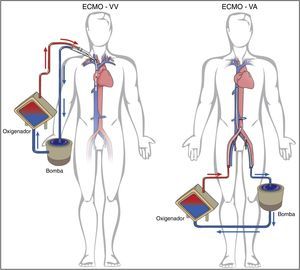 Modalidades de ECMO (venovenoso [VV], para suporte respiratório; venoarterial [VA], para suporte circulatório e/ou respiratório). Adaptado de Squiers et al.2