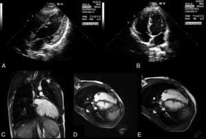 Painel A – ecocardiograma transtorácico bidimensional, projeção apical quatro câmaras modificada, demonstrando projeções miocárdicas ecodensas com morfologia em «dentes de serra». Painel B – ecocardiograma transtorácico bidimensional, projeção apical quatro câmaras modificada, demonstrando projeções miocárdicas ecodensas com morfologia em «dentes de serra». Painel C – ressonância magnética cardíaca, eixo longo duas câmaras, demonstrando projeções de miocárdio aparentemente compacto com origem na parede inferior do VE. Painel D – ressonância magnética cardíaca, corte axial quatro câmaras, demonstrando projeções de miocárdio aparentemente compacto com origem na parede lateral do VE e na face esquerda do septo interventricular. Painel E – ressonância magnética cardíaca, corte axial quatro câmaras, demonstrando projeções de miocárdio aparentemente compacto com origem na parede lateral do VE e na face esquerda do septo interventricular.