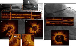 Initial coronary angiography (A, a) showing diffuse restenosis of the proximal stent and a good late result of the distal stent (arrows); optical coherence tomography (OCT) demonstrating a heterogeneous hypointensive neointima with a bright superficial layer (arrow) and presence of macrophage infiltration and microvessels (asterisk) into the neointima in the first-generation DES (B and b), and a homogeneous hyperintensive neointima in the second-generation DES (C and c); OCT post-stent (D) showing good expansion and apposition of the bioresorbable scaffold.