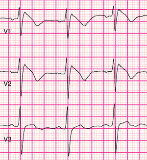 Type 1 (coved-type) Brugada syndrome electrocardiogram present in V1 and V2 (courtesy of Prof. P.G. Postema and ECGpedia.org).