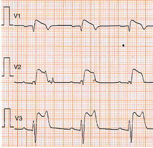 Type 1 Brugada phenocopy electrocardiogram in V1-V2 and type 2 Brugada phenocopy electrocardiogram in V3, in the context of hyperkalemia. Retrieved from Dendramis et al.78.