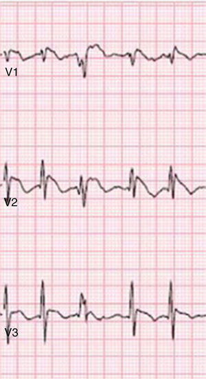 Type 1 Brugada phenocopy electrocardiogram in V1-V3, in the context of hypophosphatemia. Retrieved from Meloche et al.80.