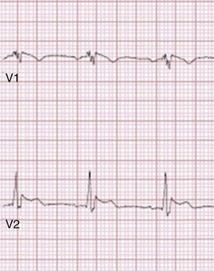 Type 1 Brugada phenocopy electrocardiogram in V1 and type 2 Brugada phenocopy ECG in V2, in the context of electrocution. Retrieved from Wang et al.85.