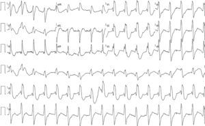 Eletrocardiograma de 12 derivações em ritmo próprio com QRS com padrão de bloqueio completo de ramo direito, intervalo PR no limite superior da normalidade, QTc: 405mseg.