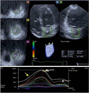Apical 4-chamber (A) and 2-chamber views (B), and different parasternal short-axis views at basal (C3), mid (C5) and superior (C7) left atrial regions, extracted from the three-dimensional volume. A three-dimensional wireframe reconstruction of the left atrium based on three-dimensional speckle-tracking echocardiographic analysis together with volumetric data and segmental (circumferential) time-strain curves are also presented. White, dashed and yellow arrows represent segmental (systolic) peak strain, (late-diastolic) strain at atrial contraction and global time-volume curve, respectively. LA: left atrium; LV: left ventricle; RA: right atrium; RV: right ventricle.