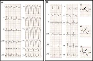 (A) 12-lead electrocardiogram (ECG) showing a wide QRS tachycardia, 190 bpm, left bundle branch block pattern with inferior axis, QS morphology in V1 and RS transition at V6; (B) 12-lead ECG after synchronized electric cardioversion revealing epsilon waves (arrows) in the right precordial leads and inverted T waves from V1 to V5.