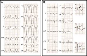 (A) 12-lead electrocardiogram (ECG) showing a wide QRS tachycardia, 190 bpm, left bundle branch block pattern with inferior axis, QS morphology in V1 and RS transition at V6; (B) 12-lead ECG after synchronized electric cardioversion revealing epsilon waves (arrows) in the right precordial leads and inverted T waves from V1 to V5.