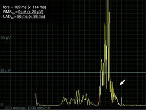 Signal-averaged electrocardiogram revealing the presence of late potentials (arrow), namely RMS40=9 μV and LAD40=56 ms. Normal values are presented in brackets. fQRS: filtered QRS duration; RMS40: root-mean-square voltage of the terminal 40 ms of the QRS; LAD40: low-amplitude (below 40 μV) signal duration.