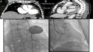 (A) Thoracic computed tomography angiogram, coronal view, showing the pseudoaneurysm and its entry site; (B) sagittal view illustrating a large heterogeneous pericardial fluid collection compressing the great vessels; (C) angiogram of the pseudoaneurysm; (D) closure device inside the pseudoaneurysm and distal disk positioned at the left ventricular wall. Ao: aorta; ICE: intracardiac echocardiography; LV: left ventricle; * pseudoaneurysm/closure device.
