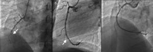 a) Trombose de stent na CD (seta); b) imagem de subtração intraluminal sugestiva de dissecção da CD (seta); c) CD pós aspiração de trombos.