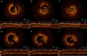 a) Dissecção da CD visível por OCT; b) e c) trombo intra‐stent na CD visível por OCT; d), e) e f) visualização da CD intra‐stent após aspiração de trombos por OCT.