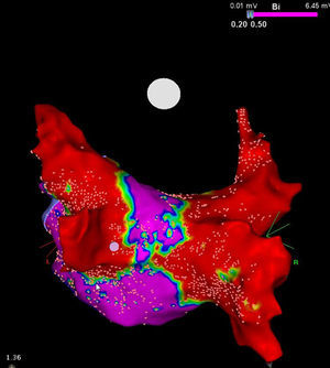 High density voltage map of the posterior wall after a cryoablation procedure in a persistent AF patient. Note the narrow corridor (purple) remaining between both large scars (red) obtained with the 28 mm Artic Front Advance™ (Medtronic, Minneapolis, MN).24 (Courtesy of Prof. Mario Oliveira, Santa Marta Hospital, Lisboa, Portugal.)