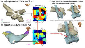 Rotors may drive recurrent AF if not fully eliminated.68 Temporospatial conservation of rotational AF sites in the inferior LA in a man with longstanding persistent AF. (A) At index procedure, anatomic roof line bisected a roof rotor; wide area PVI was also performed. The inferior LA rotor was not prospectively treated by FIRM ablation. (B) During recurrent AF 5 months later, the inferior LA rotor was still present but the previously ablated roof rotor was absent. (C) Right atrial rotor shown in index procedure (left) and 3 months later (right).