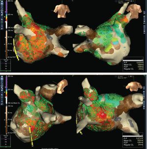 Integrated AF mapping technique: In top panel PA and AP views, whereas in bottom panel left-lateral and cranial posterior views. According to the Regular Cycle Length Map, the regions showing fast and regular activities are depicted in rainbow spectrum. The red/orange area represents region exhibiting the faster and most regular activities, while the green/blue area shows on the anterior septum another region with a relatively slower mean cycle length. Fractionated Map (brown spectrum), Voltage Map (low voltage in grey) and Conduction Velocity map (green 3D arrows) are also integrated. This Map finally shows the dominant fast and regular activity in the roof (bottom panel) with a rotational activation pattern spreading to left-sided PVs and postero-inferior wall of the LA as demonstrated by the green arrows. Secondary activity is located at the septum (light-blue). The fast and regular regions are all surrounded by the irregular fragmented zones.