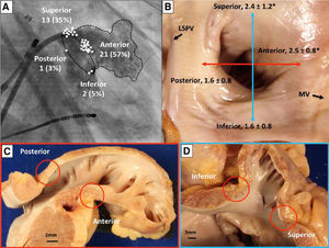 Sites of acute LAA reconnection and regional variation in LAA ostial thickness. (A) Location of acute LAA reconnection sites superimposed on right anterior oblique (35°) fluoroscopic view of the LA with contrast opacified LAA. All of the reconnection sites are located at the base of the LAA. The location of each reconnection is marked with a circle on the segment of LAA involved. (B) Gross view of non-ablated LAA, LSPV, and mitral valve. The LAA walls were cut longitudinally along the red and blue lines, and the regional LAA wall thickness was measured. Asterisks indicate significantly thicker ostial tissue at superior and anterior LAA margins compared with inferior and posterior margins (p=0.02). Sections through anterior and posterior walls (C) and superior and inferior walls (D). Note the close proximity of the left circumflex coronary artery to the anterior wall of the LAA. Adapted from Circ Arrhythm Electrophysiol. 2016;9:e003710.