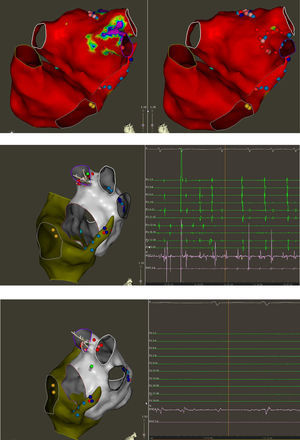 Top: Electroanatomic voltage map of a 79-year-old patient with ischemic cardiomyopathy who underwent CABG, cox-MAZE procedure and LAA ligation in 2011 for persistent AF. Patient presented to CCU with decompensated heart failure and AF with rapid ventricular response. Voltage map revealed severe right and left atrial scarring. Pre (left) and post (right) LAAEI. Note RF ablation lesions delivered at the ostium of the LAA. Middle: PentaRay catheter is in the LAA while delivering RF energy. Note that AF terminates into normal sinus rhythm. Bottom: PentaRay catheter is in the LAA showing no signals demonstrating LAAEI.