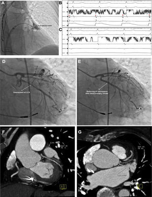 Complete occlusion of the LAA using cryoballoon (A). During cryoablation, a progressive LAA spike (B) delay resulted in LAA isolation (C). Coronary angiogram after cryoablation revealed a vasospasm at the proximal segment of the circumflex artery (D), which has been relieved by administration of intracoronary nitrate (E). Analysis of the pre-ablation computerized tomography raw data showing the close proximity of LCX with LAA ostium (F, G). *: LAA electrogram.