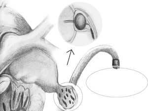 LARIAT device. See endocardial and epicardial magnet tipped guidewires in the LAA, which creates a monorail that allows the suture loop to be positioned at the base of the appendage. Necrosis of the LAA is which eventually causes LAAEI.