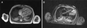 Cardiac magnetic resonance imaging in 4-chamber view showing an apical intramyocardial heterogeneous mass (*). A – First-pass perfusion; B – Myocardial delayed enhancement.