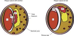 Comparison between coronary plaque rupture with exertion and at rest (reprinted from Burke et al.22). HP: hemorrhage into plaque; L: lumen; Th: thrombus.
